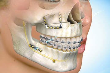 Bucomaxilofacial